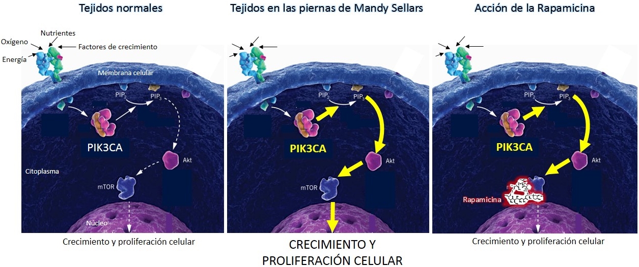 Modelo simplificado que ilustra la causa de la enfermedad de Mandy Sellars y el tratamiento con Rapamicina.